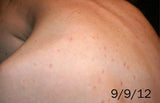 Molluscum Contagiosum Treatment Value Pack