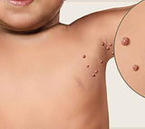 Molluscum Contagiosum Treatment For Children And Adults - 15ml