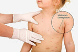 Molluscum Contagiosum Treatment Value Pack