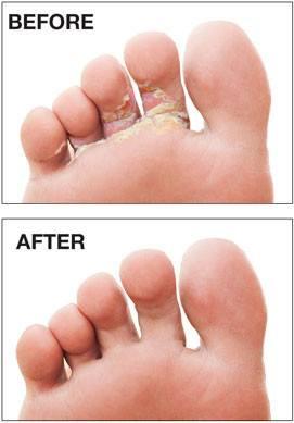 Athlete's Foot Treatment - 15ml